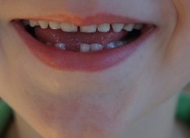Perfekte børn har tandimplantater