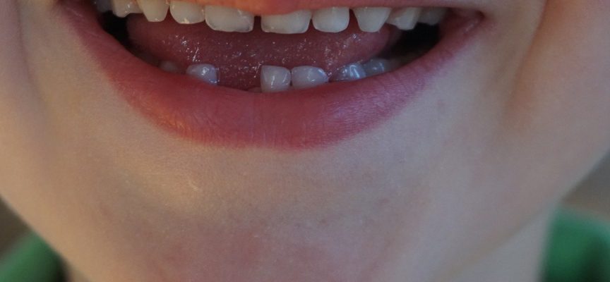 Perfekte børn har tandimplantater